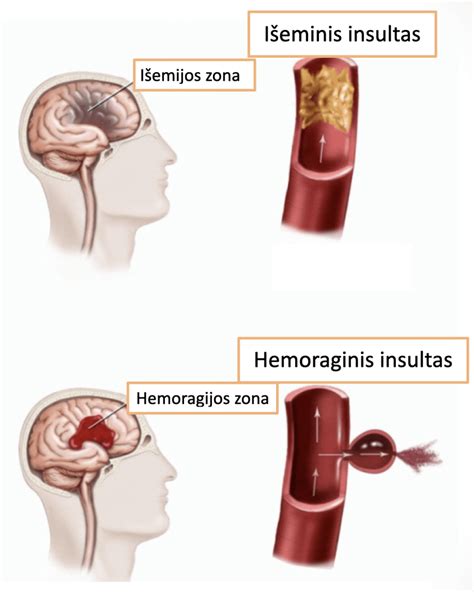 naujagimio galvos smegenų kraujosruvos požymiai