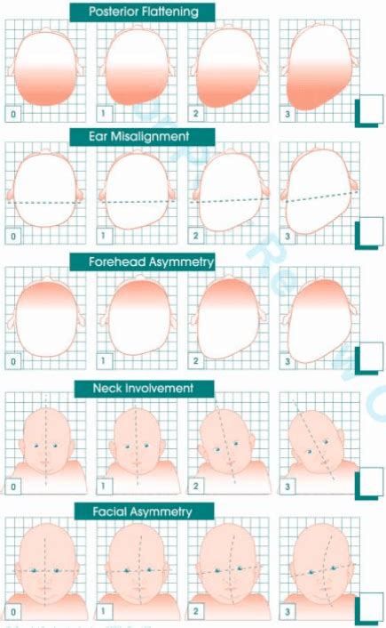 schema of plagiocephaly