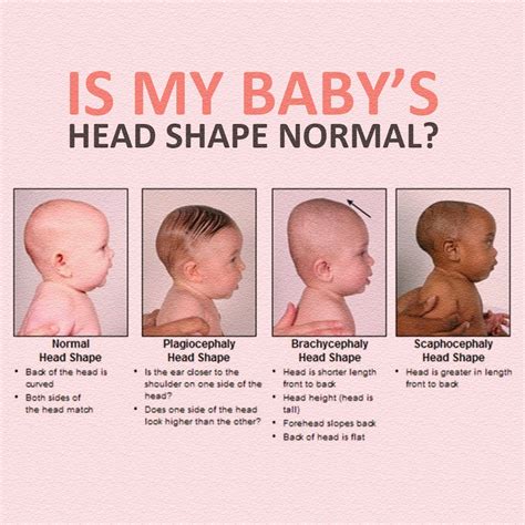 baby head shape comparison photos