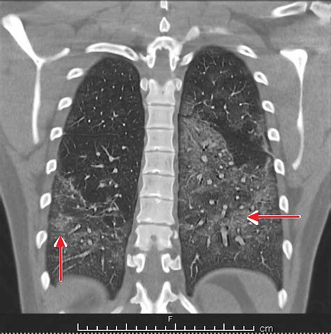 EVALI sindromo schema