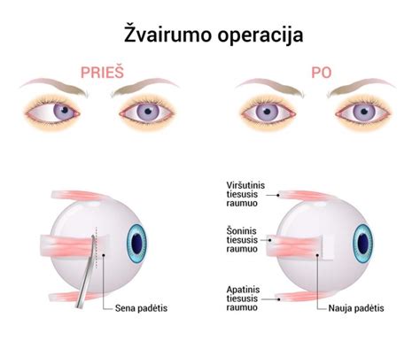 Palyginimas: normalus erdvinis matymas ir žvairumo sukeltas plokščias matymas