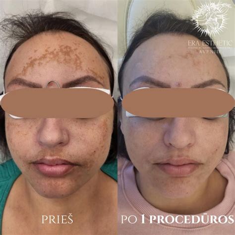 Pavyzdys pigmentinių dėmių nėštumo metu (melazma)