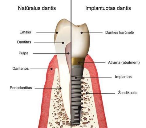 Danties implantavimo schematinis vaizdas