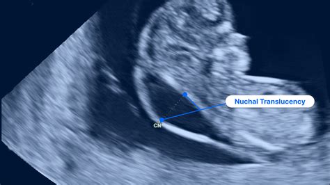 Nuchal translucency (NT) matavimas echoskopijos metu