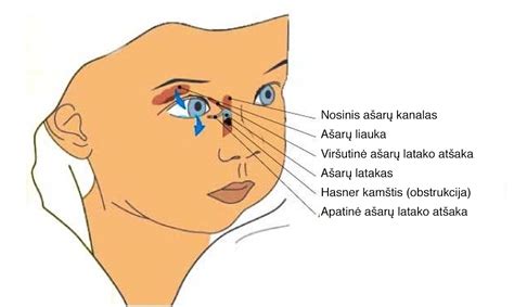 nosinio ašarų kanalo obstrukcija schema
