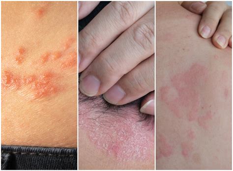 Naujagimio odos bėrimai