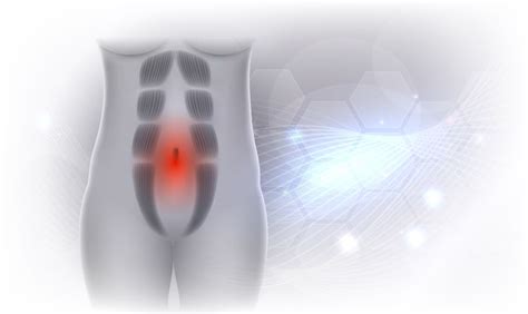 Pilvo raumenų diastazė: schema